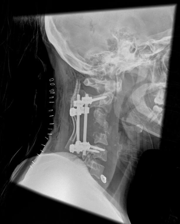 Spine Neurosurgery Case