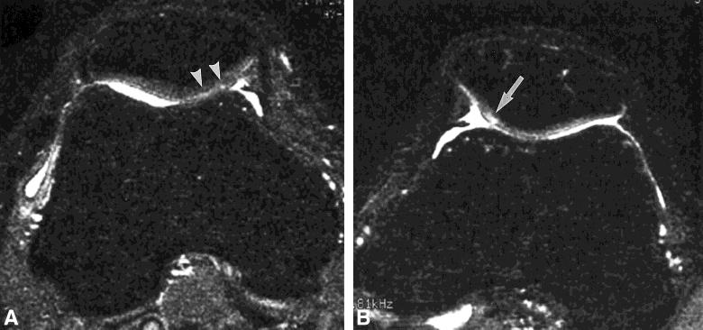 Sensitivity, specificity, and accuracy of IR-FSE imaging in terms of making a correct grading of the chondromalacia were 57.1%, 93.0%, and 90.1%, respectively.