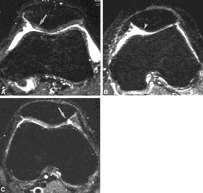IR-FSE Imaging for Chondromalacia of the Patella 415 Figure 4. False-positive cases.