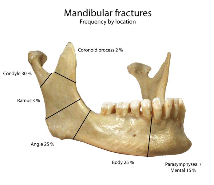 Specific Injuries Mandible The mandible is the single facial bone in the lower third of the face. Because of its prominence, fractures to this bone rank second in frequency after nasal fractures.