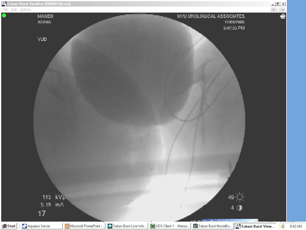WNL BUN and creatinine WNL Cystoscopy and bladder bx s normal Videourodynamics IDC Void Void Outcome 3.