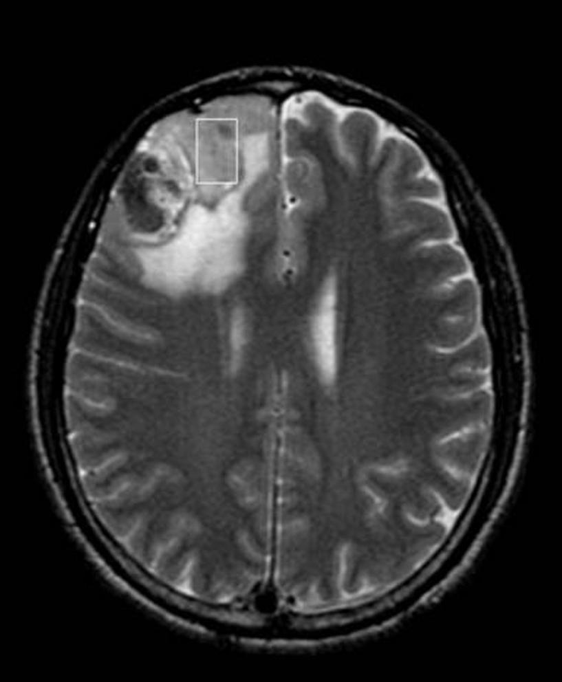 Kim et al. A B C D E Fig. 3. A 49-year-old man with anaplastic oligodendroglioma. A. The axial T2-weighted image reveals a heterogenous mass with probable hemorrhagic portion in the right frontal lobe.