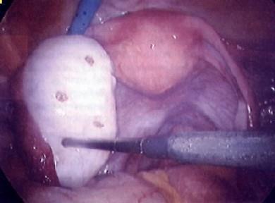 Laparoscopic ovarian drilling: with either diathermy or laser, lead to
