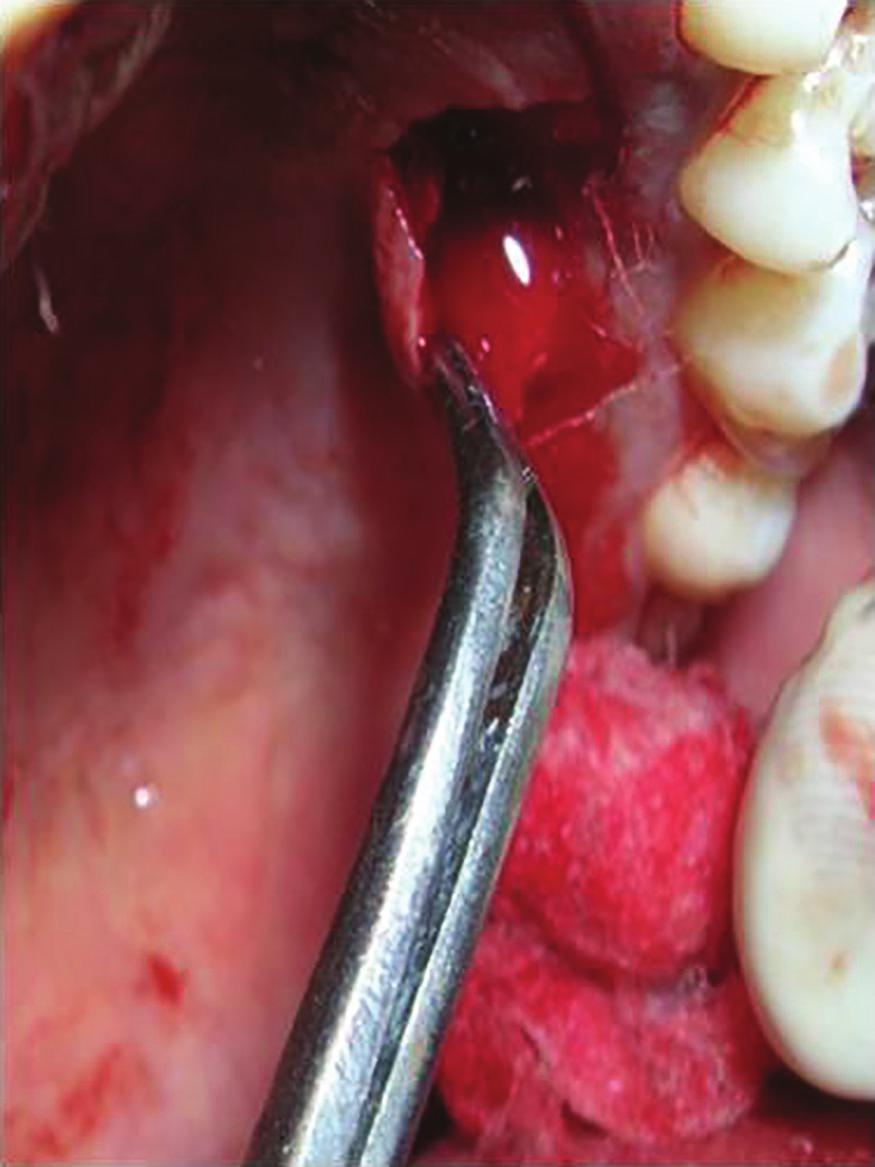 Figure 9: Suturing of vertical incisions using 5-0 mersilk suture without tension. Figure 6: Donor site in the palate used for harvesting the subepithelial connective tissue graft.