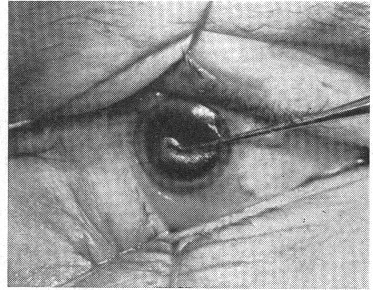 630 TADEUSZ KRWA WICZ deep layers of the corneal stroma, sometimes very close to Descemet's membrane (Fig. 1).