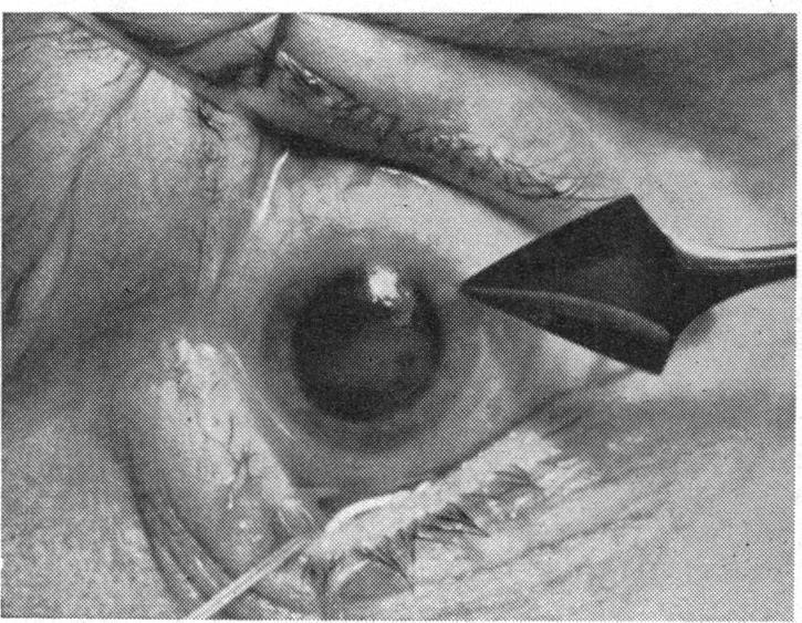 In the central part of the cornea the scar tissue is undermined through a slightly broader area (Fig. 2). OXas..,0>'T _.;;...:. FIG. 1.-An incision about 4 mm.