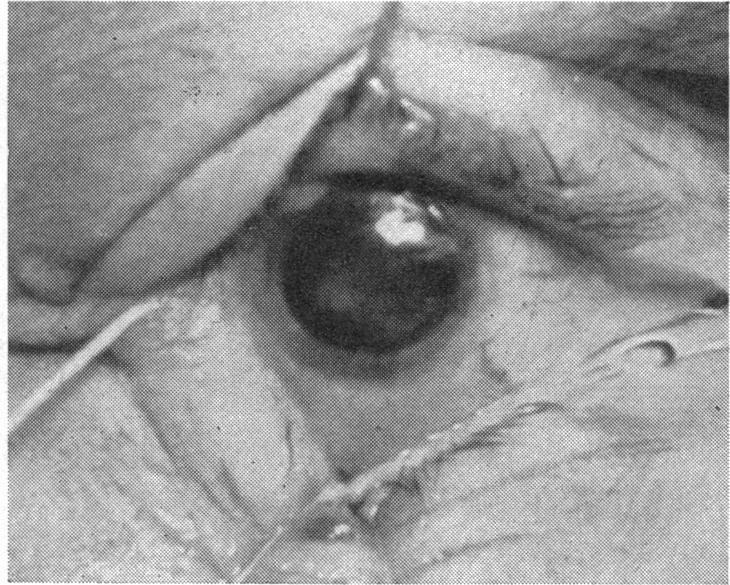 walls of the pocket (Figs 3 and 4). FIG. 3.-Graft introduced under scar. FIG.4.-Gafi pa..- FIcG. 4.--raft in place. Atropine and antibiotics are introduced into the conjunctival sac.
