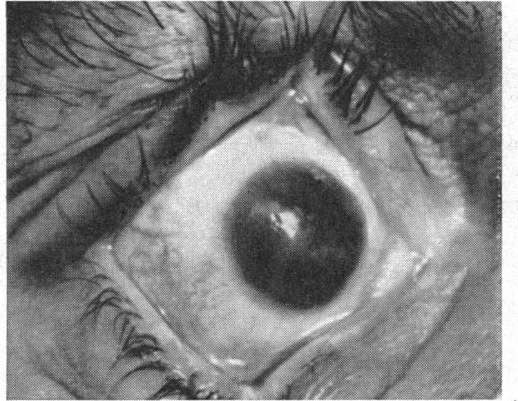 INTRA-CORNEAL LAMELLAR KERATOPLASTY small visual gain must be ascribed to co-existing pathological changes in the ocular media and in the fundus.