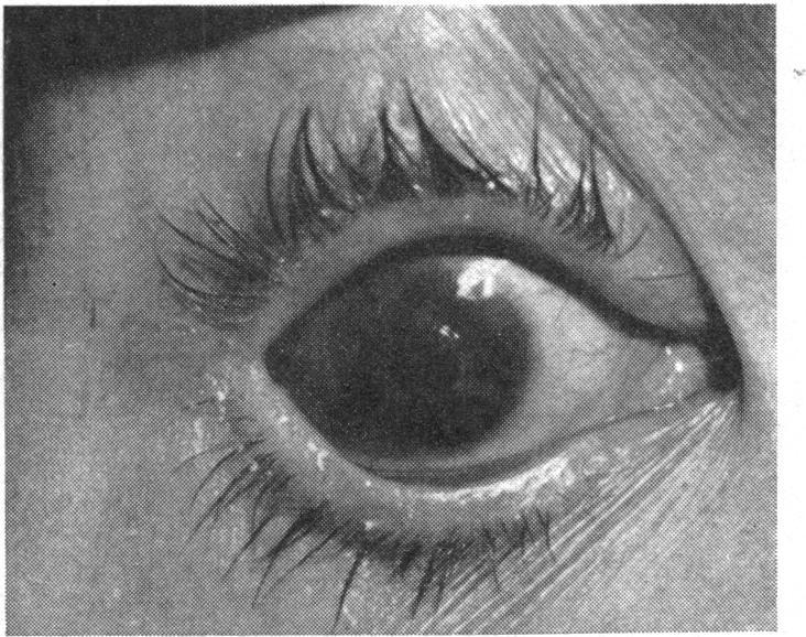 There is no evidence that the 6 to 8 days' stay inside the corneal pocket has a negative influence on the clarity of the graft.