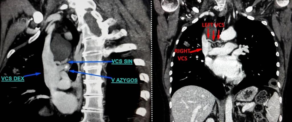 Fig. 9: CT presentation for distal half ot the atypical LSVC that goes in right superior vena cava along the route
