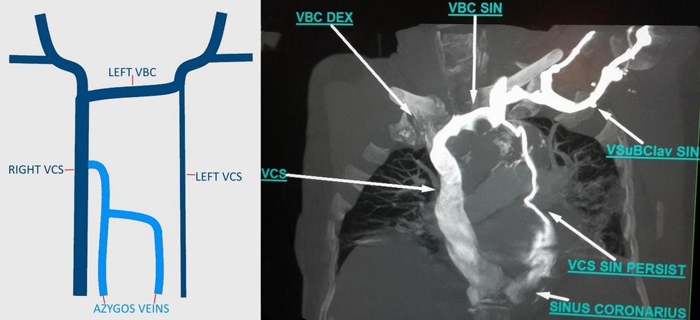 Fig. 5: Schematic and CT presentation of hypoplastic left superior vena cava draining in coronary sinus (common variant) with dominant left brachiocephalic vein.