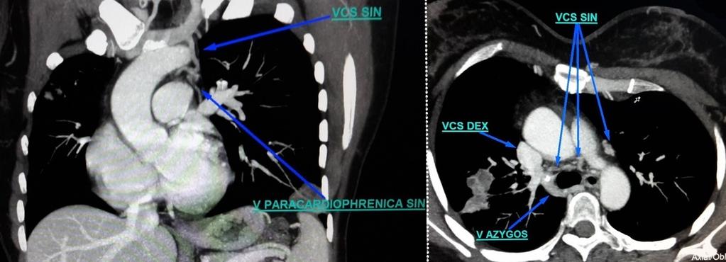 8: CT presentation for proximal half of the atypical LSVC.