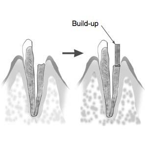 Trouble Shooting: A Broken Crown If the crown of the tooth is broken and a section of the gingival tissue intrudes into the cavity surrounding the canal opening, contact between the gingival