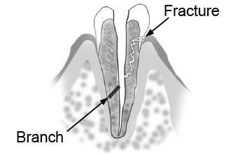 Trouble Shooting: A Fractured Tooth/Branch Canal A fractured tooth or branch