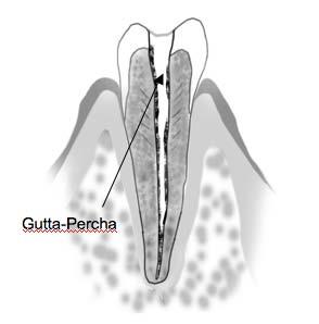 Trouble Shooting: Re-Treatment of a Root Filled with Gutta Percha In this case, the gutta percha must be completely removed before a measurement is