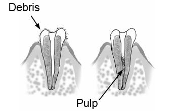 Trouble Shooting: Cutting Debris on the Tooth/Pulp from the Canal Thoroughly remove all cutting debris on the
