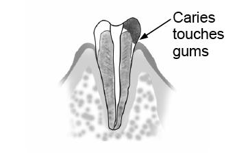 Trouble Shooting: Caries Contacting Gingival Tissue In this case, electrical leakage via the