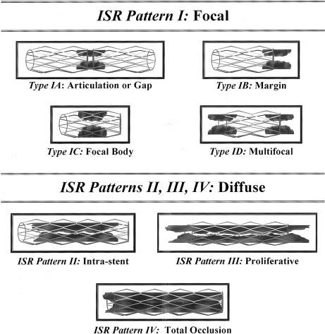 Mehran et al Classification of In-Stent Restenosis 1873 body of the stent, the proximal or distal margin (but not both), or a combination of these sites (multifocal ISR) Class II: Diffuse intrastent