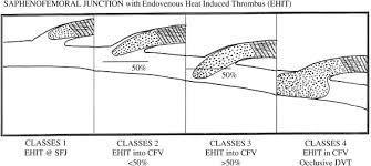 Kabnick Classification Extension of thrombosis: Class I: Up to the junction of superficial and deep venous systems.