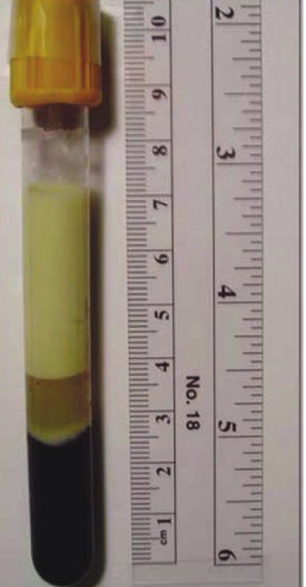 Q) serum sample from a patient had a milky appearance and produced very high TG content. A-What lipoprotein is causing this? B-And what is the clinical significance of this test result?