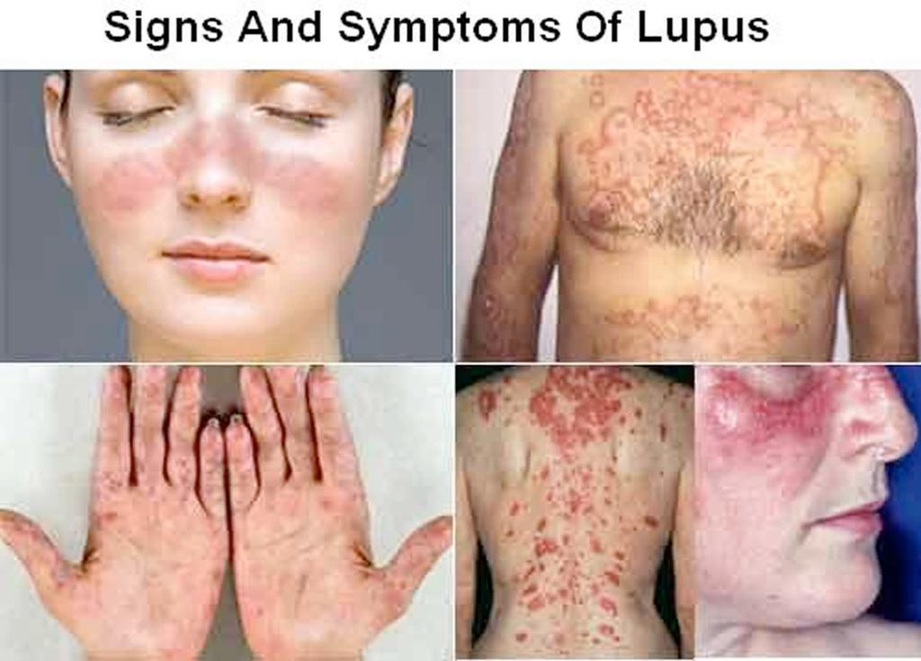 Antibody-Mediated Systemic Autoimmunity Systemic lupus