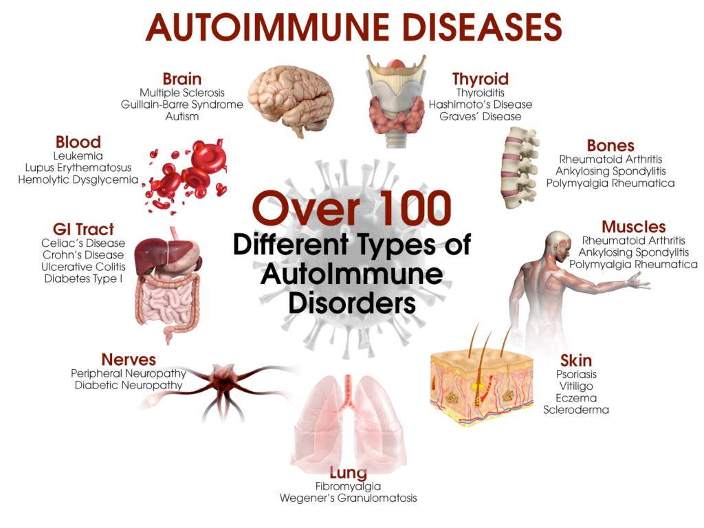 Autoimmune Diseases Any organ/organ system in the body