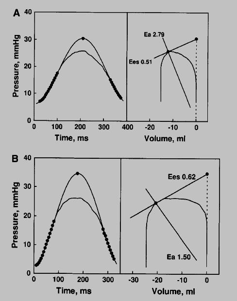 Effect of PGI2 in PH on RV stroke