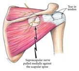 Supracapular Nerve: Rotator Cuff Tear Association How Can It