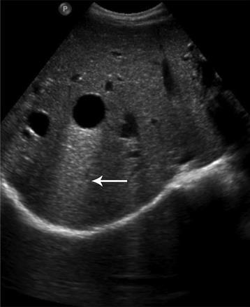 surrounding tissue affect the appearance of the ultrasound image?