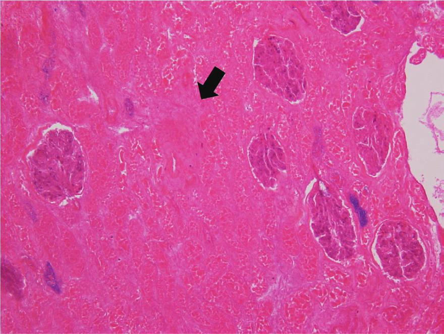 . Photomicrograph of histologic specimen shows coagulative necrosis (arrow) in kidney tissue (hematoxylin and eosin stain, 100).