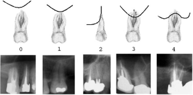 0 1 2 3 4 Figure 1. Relation between the roots of posterior maxillary teeth and the maxillary sinus floor in panoramic hfakhar s and Sharan s studies, respectively [2, 14].