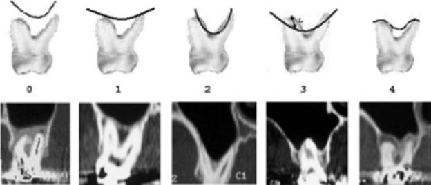Since first premolars mostly and second premolar sometimes are in vertical relation with class 0 or 2, panoramic results can be used for premolar areas.