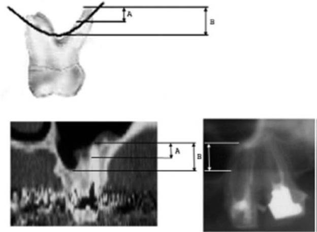 Figure 3. Measurement in CBCT according to longitudinal axis of root teeth distance from the sinus.