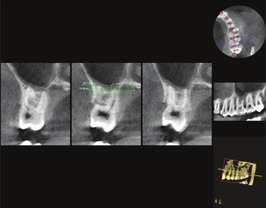 Correlation and Regression analyses were used to Figure 1: DVT showing the relation of maxillary left second pre molar with floor of the sinus in axial, coronal and sagittal sections and 3D