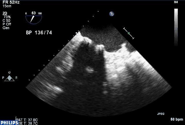 2D TEE: Starr-Edwards Mitral Valve 12 77-year-old