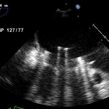 IMAGING OF PROSTHETIC VALVES St. Jude mitral valve in anti-anatomic position.