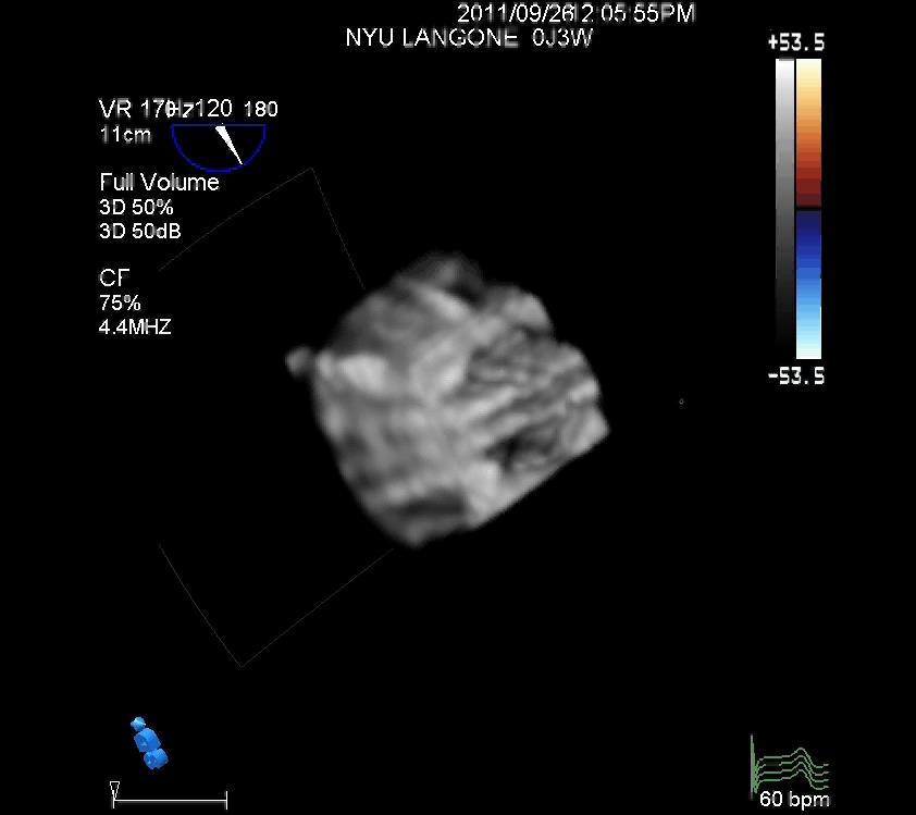 3D TEE: St Jude MVR 44 AV LAA Atrial Septum PVL Physiologic Jets Coronary Sinus St.