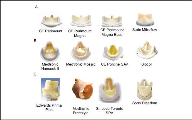 Bioprosthetic Valves 51 Bovine pericardium Porcine aortic valve Stentless