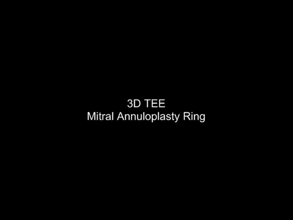 Mitral Ring Annuloplasty 76 NYU