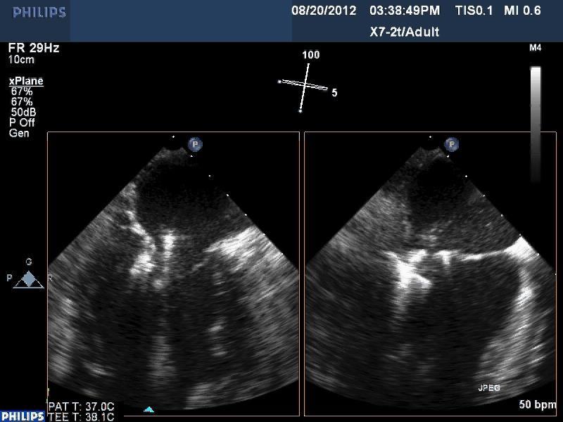 Percutaneous Mitral Clipping: Clip Being Deployed 87