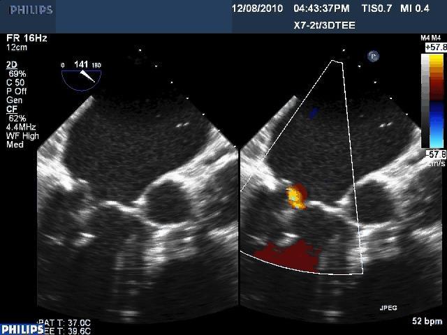 Percutaneous Mitral Clipping: Final Result 91 Post clipping: Only