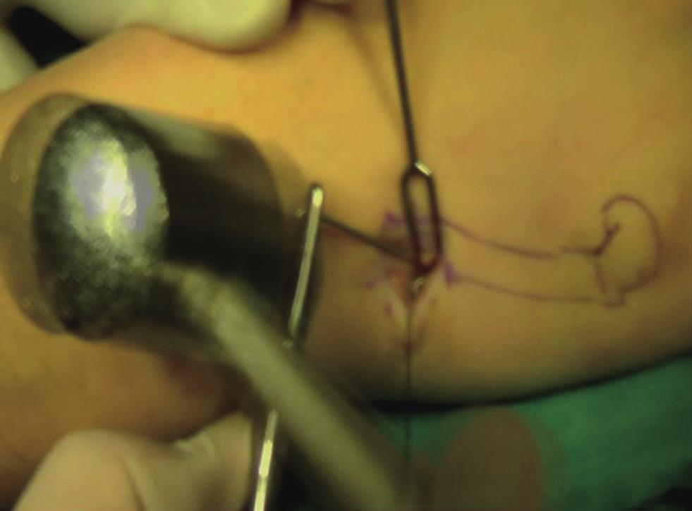 Moon SJ et al. nail vs. K-wire fixation Fig. 3. K-wire advancement When advancing the inserted K-wire, we used a small mallet to prevent inadequate supplementary bending of the K-wire. Fig. 5.