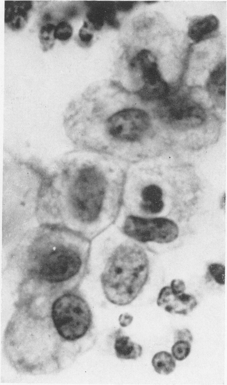 Such cells have often been designated phagocytes or histiocytes by cytologists but are probably epithelial cells invaded by leucocytes before exfoliation.
