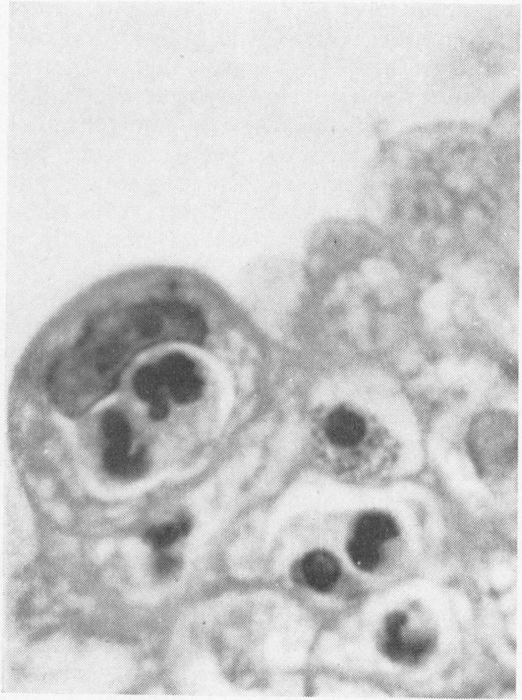 FIG. 6 FIG. 7 The permeation ofgastric epithelial cells by leucocytes 163 FIG. 6. Cells near the surface of gastric epithelium illustrating the histological appearances of leucocytic permeation.