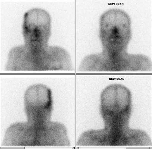 SSM Wong, K Wang, EHY Yuen, et al (a) (b) Figure 2. Patient 1: (a) The images show early post-mastoidectomy planar Gallium scan and follow-up scan with residual mild inflammation only.