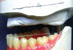 The wax rim should to get parallelized before by the treating dentist.