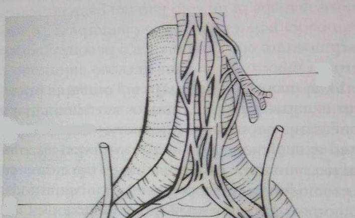 NERVE SPARING TECHNIQUE 2nd STEP proximally, the sympathetic fibers of the Para-aortic Trunks, and of the Inferior Mesenteric Plexus,