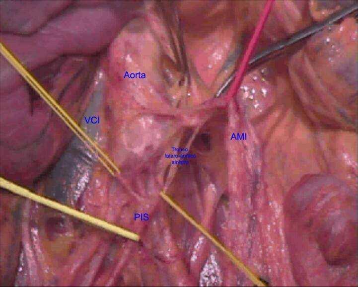 Sites of risk of NERVE DAMAGE INFERIOR MESENTERIC ARTERY The risk in the abdomen occurs during ligation of the
