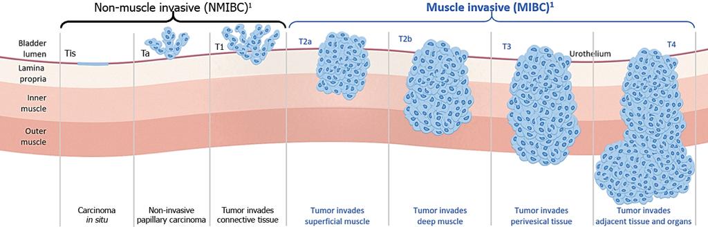 PROGRESSIVE NATURE OF BLADDER CANCER CIS 60%-70% will recur 1 20%-30% will progress to muscle invasive bladder cancer 1 1 Aldousari,