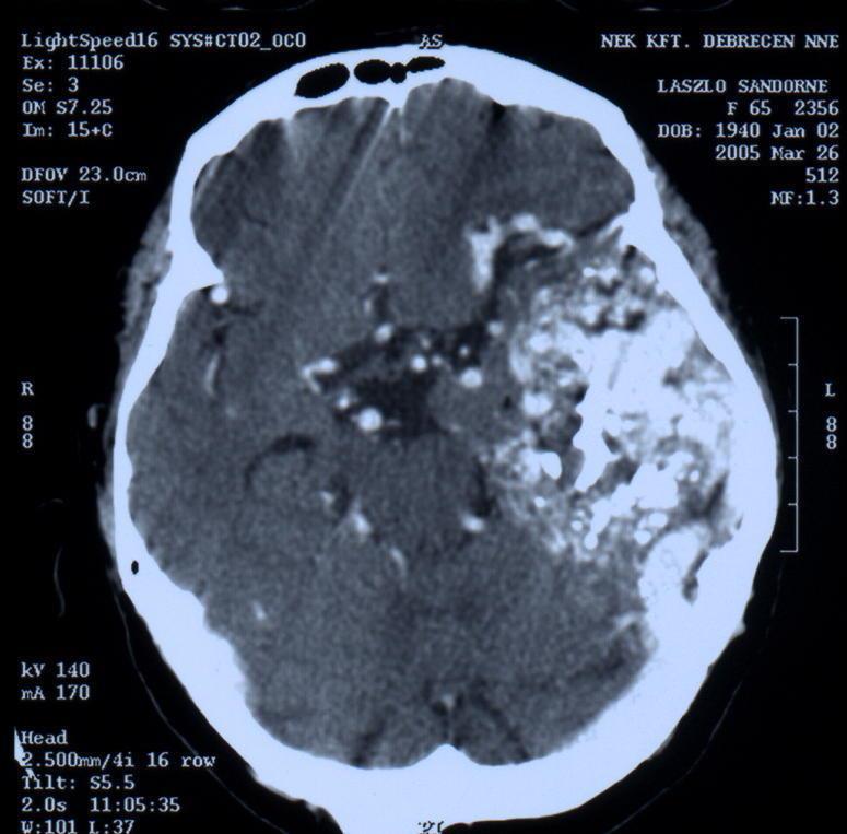 Angioma known since 40